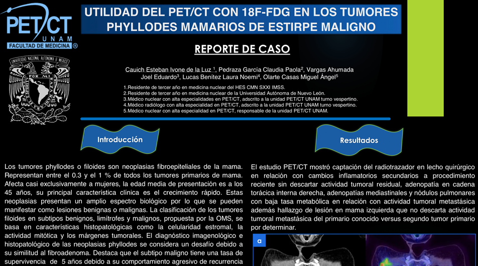 CARTEL UTILIDAD DEL PETCT CON 18F-FDG EN LOS TUMORES PHYLLODES MAMARIOS DE ESTIRPE MALIGNO.png